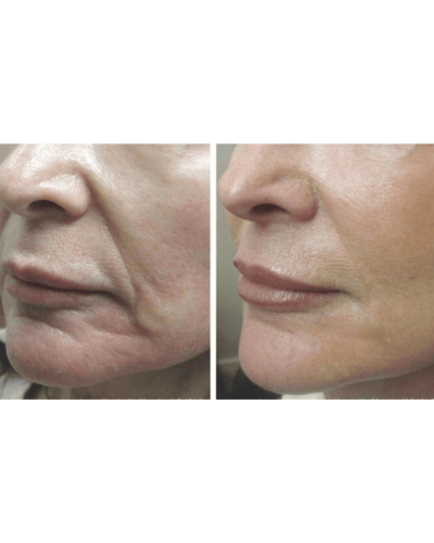 МИКРОТОКОВЫЙ ЛИФТИНГ-МАССАЖЕР ДЛЯ ТЕЛА MEDICA+ SKIN LIFTING 5.0 ЯПОНИЯ МИКРОТОКОВЫЙ ЛИФТИНГ-МАССАЖЕР ДЛЯ ТЕЛА MEDICA+ SKIN LIFTING 5.0 ЯПОНИЯ