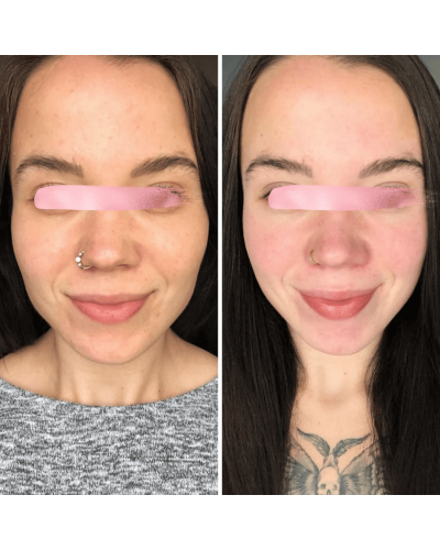 EMS МИКРОТОК MEDICA+ ЛИФТИНГ-МАССАЖЕР для лица SKIN LIFTING 6.0 PINK (ЯПОНИЯ) EMS МИКРОТОК MEDICA+ ЛИФТИНГ-МАССАЖЕР для лица SKIN LIFTING 6.0 PINK (ЯПОНИЯ)