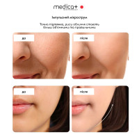 Массажер для лица MEDICA+ SkinLifting PRO 10x с микротоками, RF и функцией лифтинга
