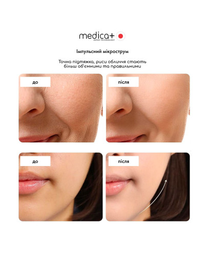 Масажер для обличчя MEDICA+ SkinLifting PRO 10x з мікрострумом, RF та функцією ліфтингу Масажер для обличчя MEDICA+ SkinLifting PRO 10x з мікрострумом, RF та функцією ліфтингу