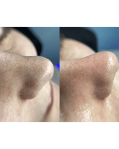 УЛЬТРАЗВУКОВОЙ СКРАБЕР ДЛЯ ЛИЦА MEDICA+ VIBROSKIN 8.0 (ЯПОНИЯ) УЛЬТРАЗВУКОВОЙ СКРАБЕР ДЛЯ ЛИЦА MEDICA+ VIBROSKIN 8.0 (ЯПОНИЯ)