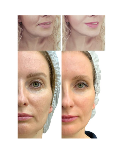 МІКРОСТРУМОВИЙ RF ЛІФТИНГ-МАСАЖЕР ДЛЯ ОБЛИЧЧЯ MEDICA+ SKIN LIFTING 7.0 WHITE ЯПОНІЯ (EMS+LED) МІКРОСТРУМОВИЙ RF ЛІФТИНГ-МАСАЖЕР ДЛЯ ОБЛИЧЧЯ MEDICA+ SKIN LIFTING 7.0 WHITE ЯПОНІЯ (EMS+LED)