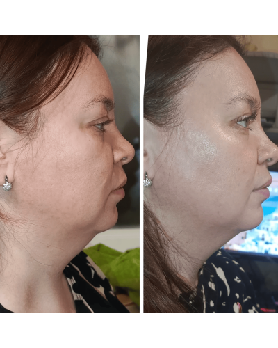 Мікрострумовий RF Lifting Масажер для обличчя Skin Lifting 7.0 Pink - EMS, LED Мікрострумовий RF Lifting Масажер для обличчя Skin Lifting 7.0 Pink - EMS, LED